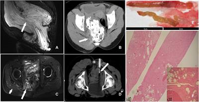 Aggressive angiomyxoma of the pelvis and abdominal wall: Dramatic response to chemical ablation therapy